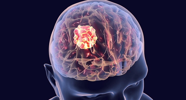 اليوم العالمي لأورام المخ.. الأعراض وأهمية التشخيص المبكر