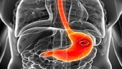تعرف على أعراض وطرق علاج سرطان المعدة